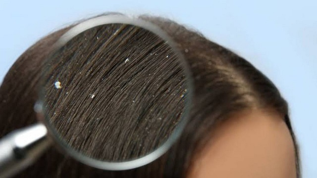 Saçların Kepeklenmesini Önlemek (Şifalı Bitkilerle)